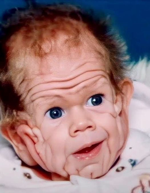 In 1993, This Boy Was Born With Enough Skin For A Five-Year-Old. But Wait Till You See Him Today