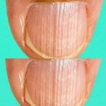 Having Striped Nails Could Mean That Your Body Is… Read More