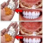 Natural Teeth Whitening – Say Goodbye to Yellowing and Tartar