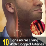 10 Signs You’re Living With Clogged Arteries Uncategorized admin · January 4, 2025 · 0 Comment