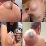 🚨🚨Doctors Couldn’t Believe What Was Inside This Swelling… See for Yourself!