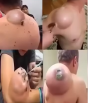 🚨🚨Doctors Couldn’t Believe What Was Inside This Swelling… See for Yourself!