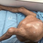 😥 Doctors Remove 76-Pound Tumor from Man’s Leg in Life-Saving Surgery That Stunned Medical Experts