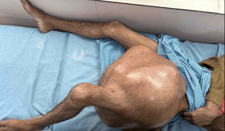 😥 Doctors Remove 76-Pound Tumor from Man’s Leg in Life-Saving Surgery That Stunned Medical Experts
